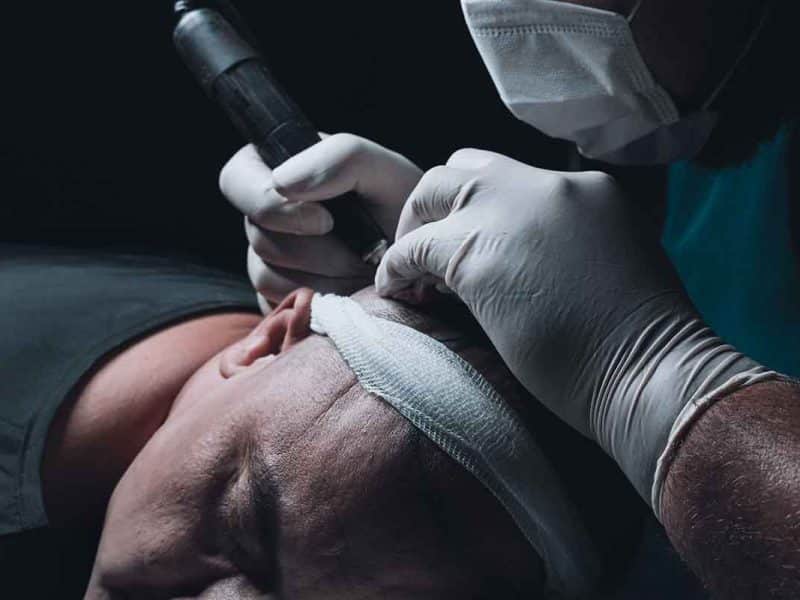 Hair loss, robot transplants: Inside the multi-billion dollar industry battling baldness